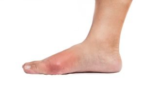 Painful gout inflammation on big toe joint of the foot