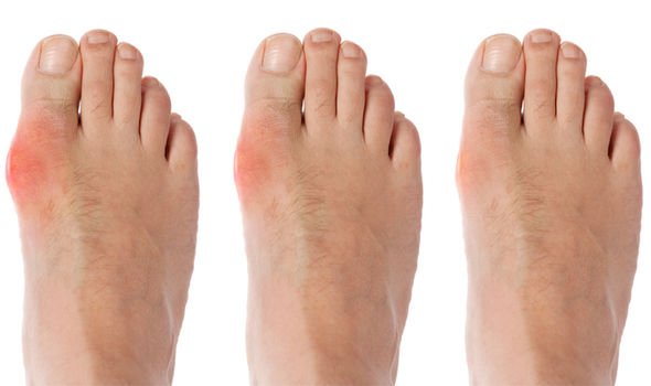 Additional Tips For Treating Gout Naturally