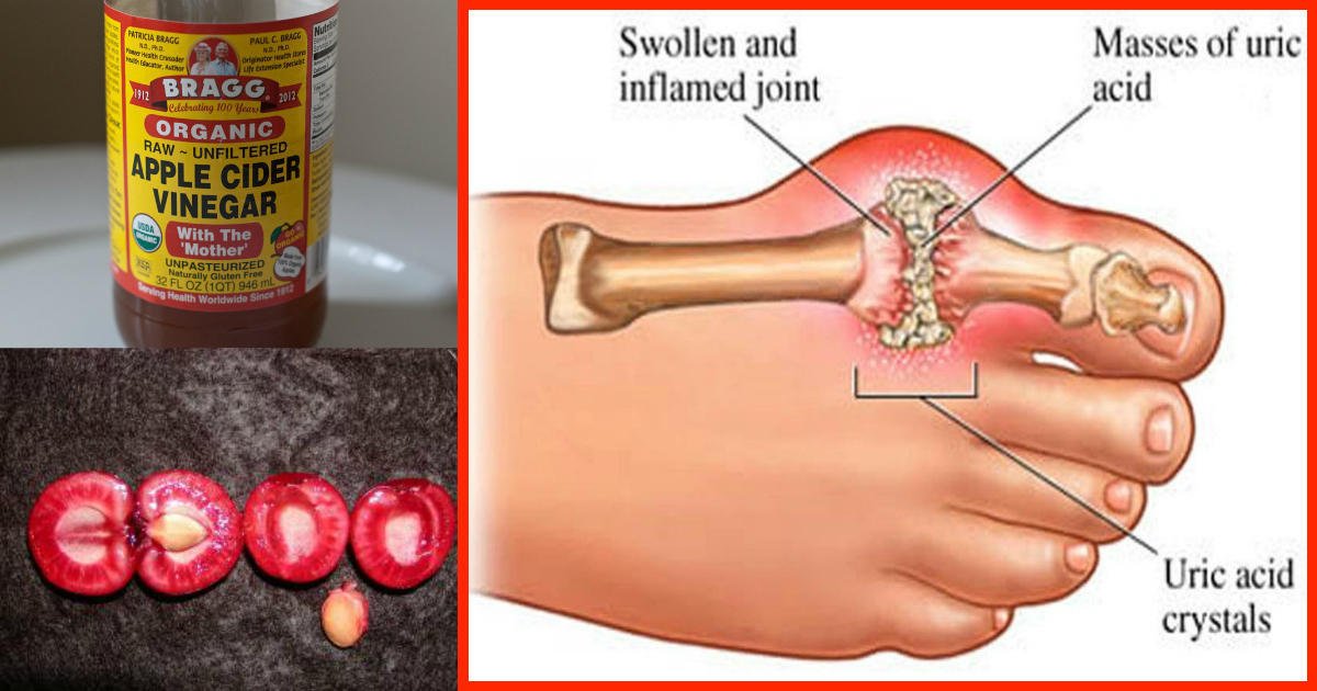 Here Is How To Eliminate Uric Acid Crystallization From Your Body To 