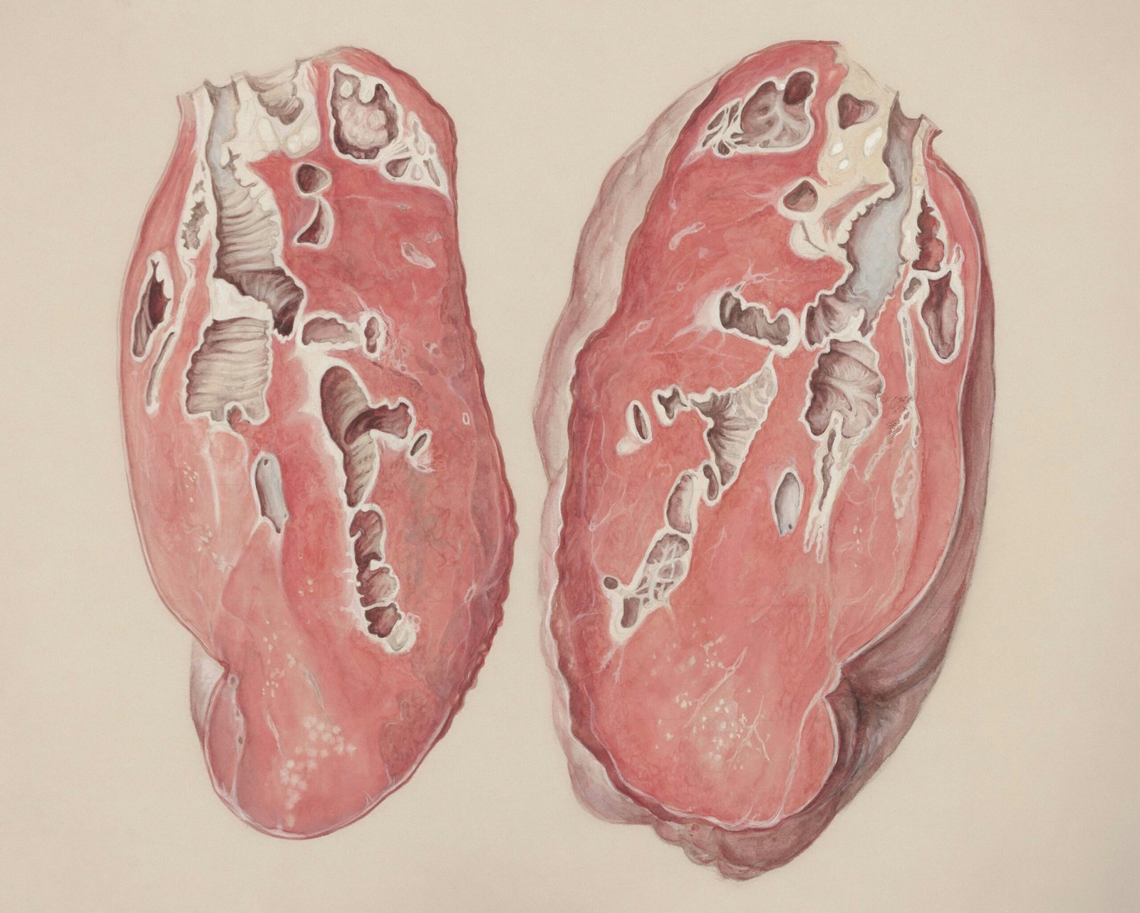 How Do They Determine If You Have Gout?